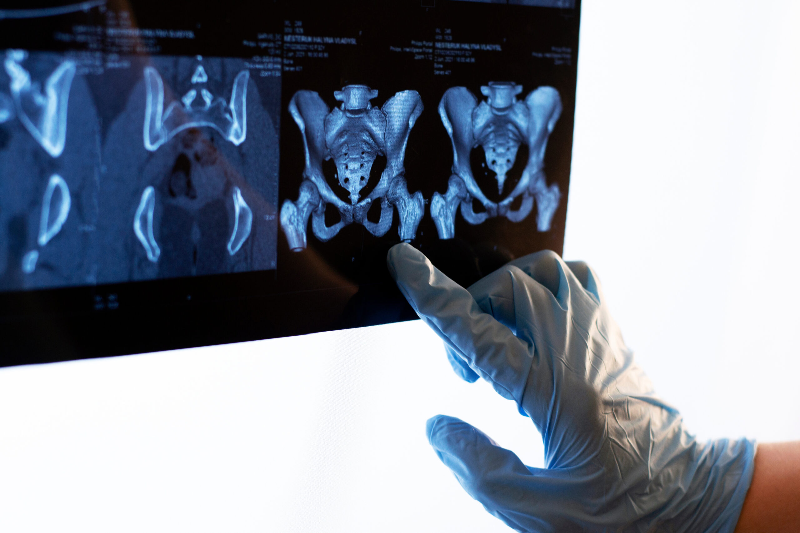 Sacroiliac (SI) Joint Anatomy